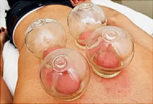 Client receiving Cupping Treatment