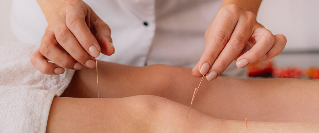 Acupuncture Client receive treatment for Chronic pain