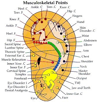 Ear Seeds placement