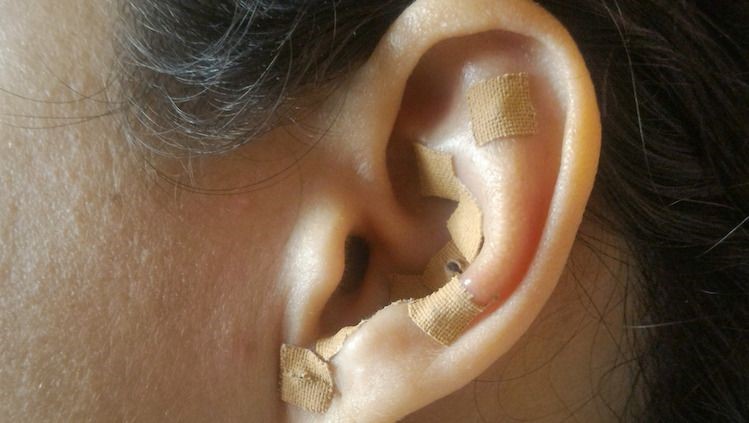 Ear Seeds Therapy